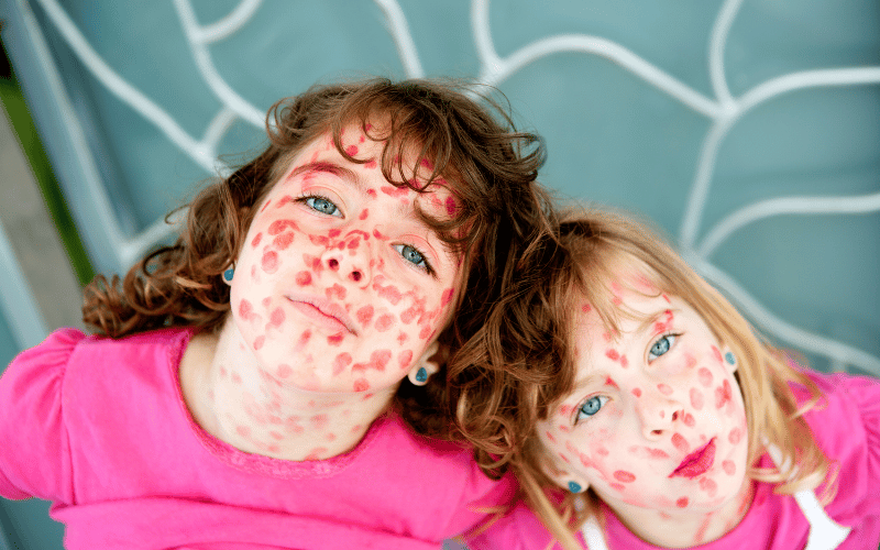 The Rash Measles’ Hallmark Presentation