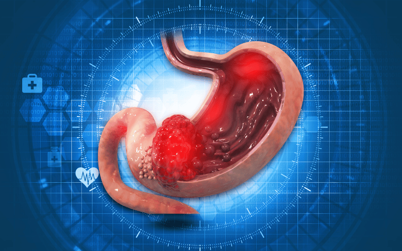 The Role of Tumor Size