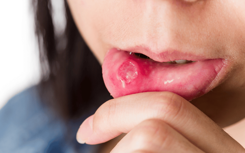 The Untold Story of Aphthous Stomatitis 10 Symptoms You Need to Know