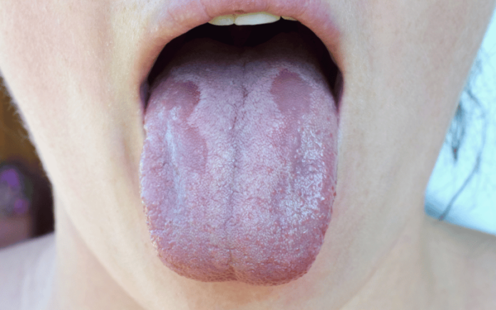 Top 10 Causes Of Oral Thrush Oral Candidiasis Everyone Should Know