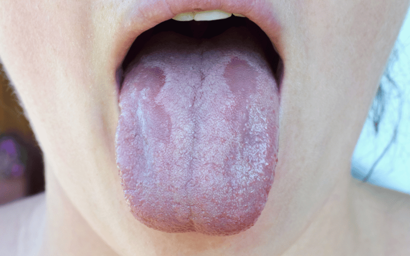 Top 10 Causes of Oral Thrush (Oral Candidiasis) Everyone Should Know