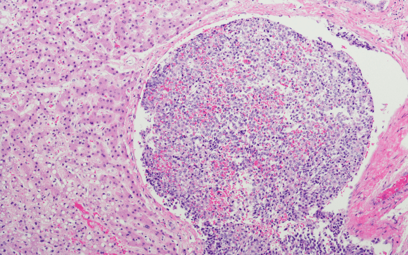 Understanding Hepatoblastoma