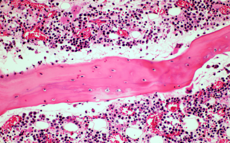 Understanding the 4 Stages of Adenoid Cystic Carcinoma (ACC)