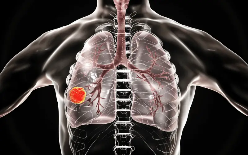 Understanding the 5 Stages of Lung Carcinoma A Deep Dive into Symptoms, Treatments, and Prognosis
