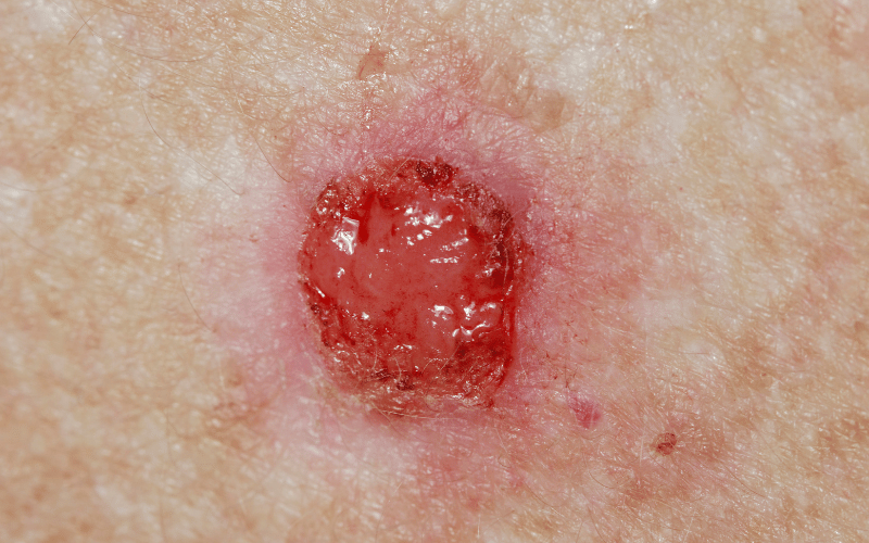 Unveiling the 5 Stages of Basal-Cell Carcinoma