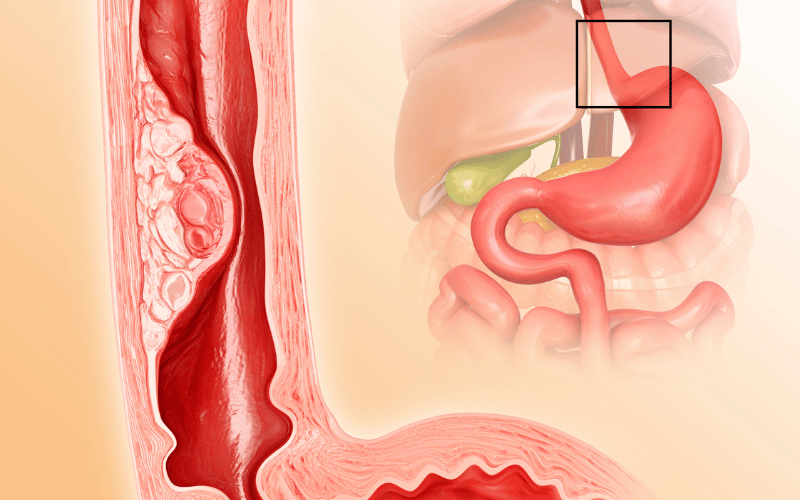 What is an Esophageal Ulcer