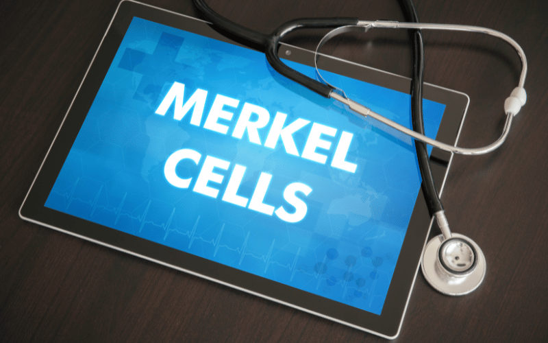 10 Pivotal Points on Merkel-cell Carcinoma The Life Expectancy Discussion