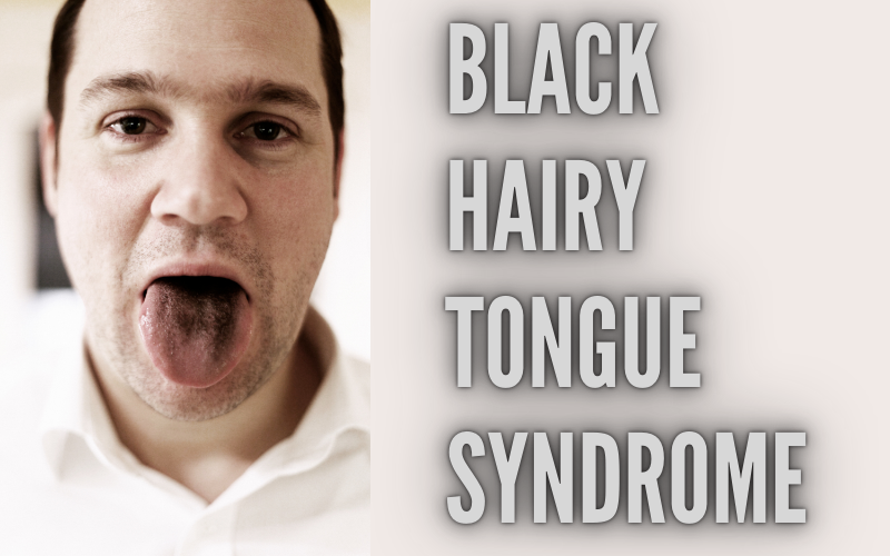 Black Hairy Tongue Syndrome 10 Facts to Enhance Your Understanding