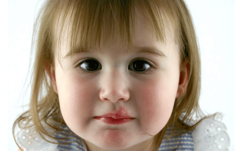 Cold Sore Symptoms in Kids What Every Parent Should Know