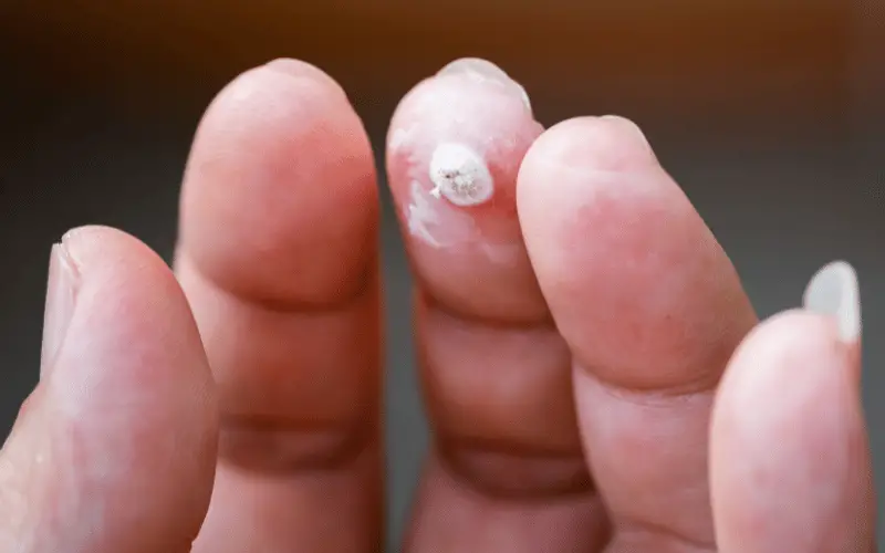 Filiform Warts What They Are and How to Tackle Them