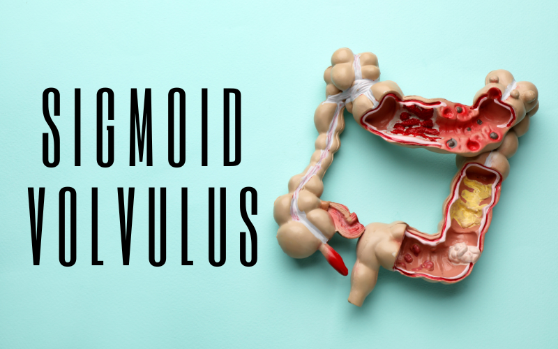 Heed the Warning Top 10 Symptoms of Sigmoid Volvulus