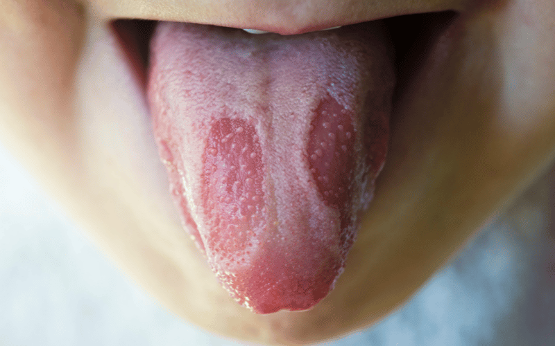 Home-based Healing Top 10 Remedies for Geographic Tongue Relief