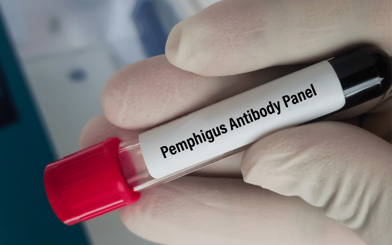 Recognizing Pemphigus A Closer Look at the Top 10 Symptoms