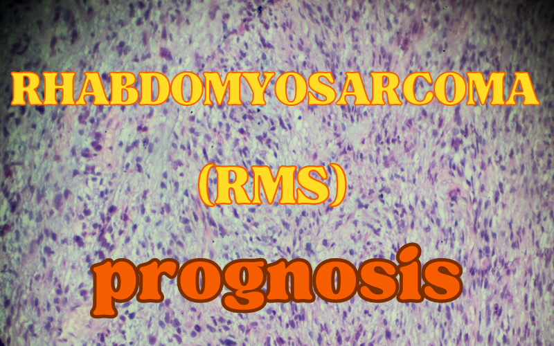 Rhabdomyosarcoma and its Forecast 10 Prognostic Touchpoints