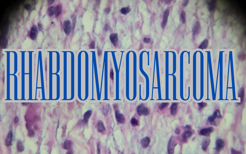 Rhabdomyosarcoma in Focus Top 10 Symptoms to Be Aware Of