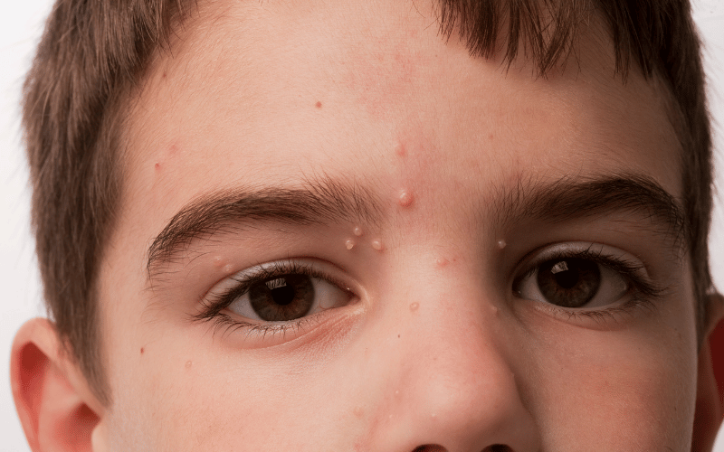 Skin Stories Molluscum Contagiosum and its 10 Telltale Signs