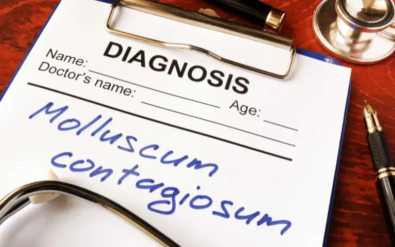 The Real Deal about Molluscum Contagiosum 15 Essential Facts