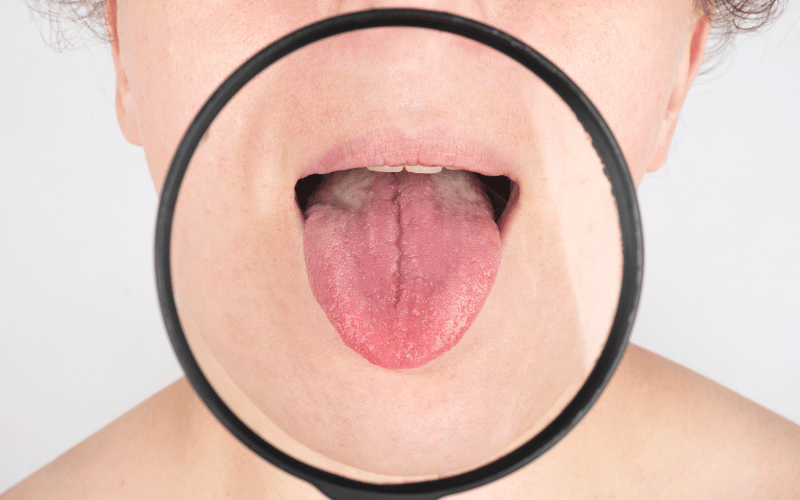 Tongue Check Recognizing the 10 Symptoms of Median Rhomboid Glossitis