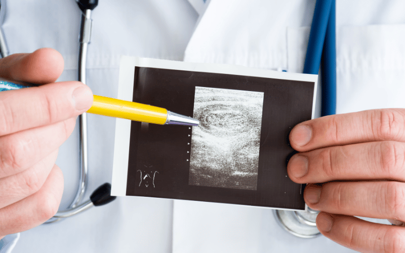 Understanding Intussusception A Deep Dive into Its 10 Key Symptoms