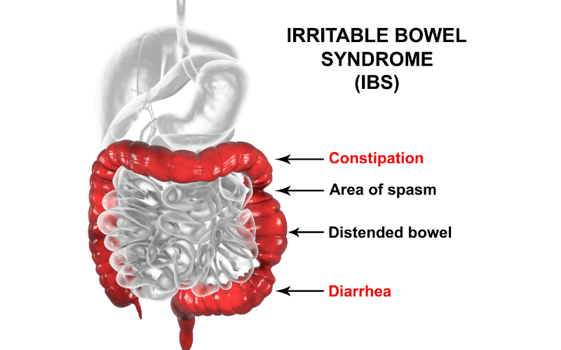 Unveiling the 10 Key Signs of Irritable Bowel Syndrome