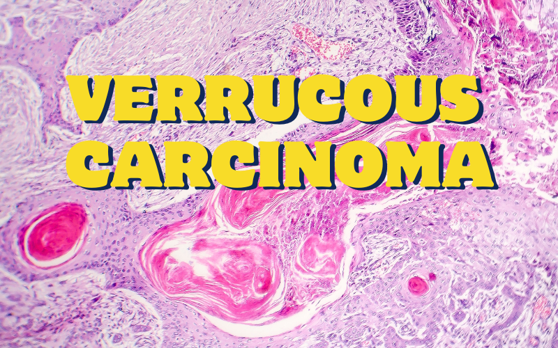 Verrucous Carcinoma Signs Awareness is the First Step