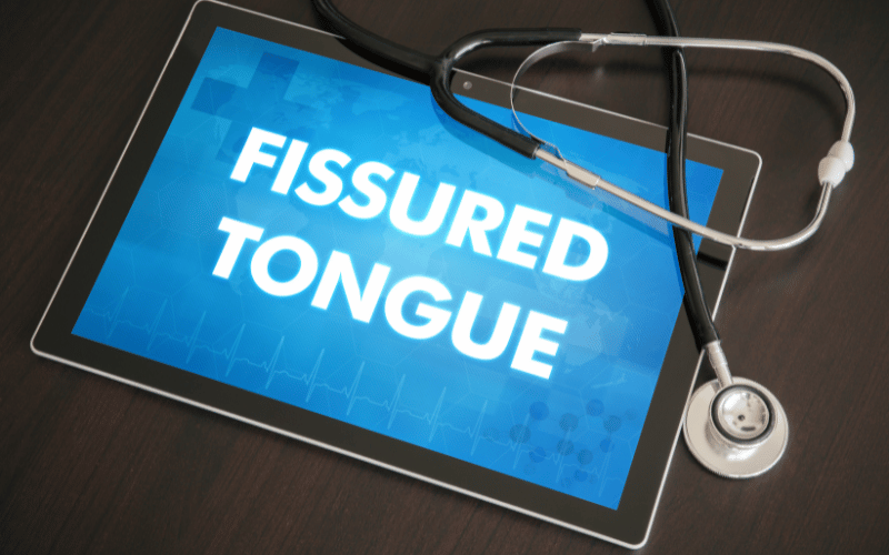 What Causes Fissured Tongue A Close Examination of the Top 10 Factors