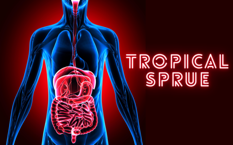 What Is Tropical Sprue Unveiling Its 10 Key Symptoms