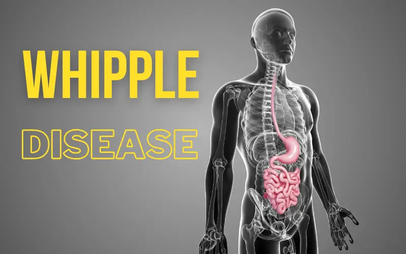 Whipple Warnings The 10 Tell-Tale Symptoms of the Disease