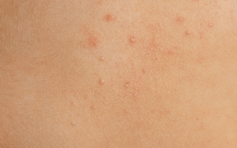 Flesh-Colored Bumps Molluscum Contagiosum's Telltale Mark