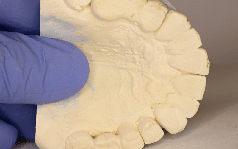 Hard Bony Growth in the Center of the Palate Nature's Dental Surprise