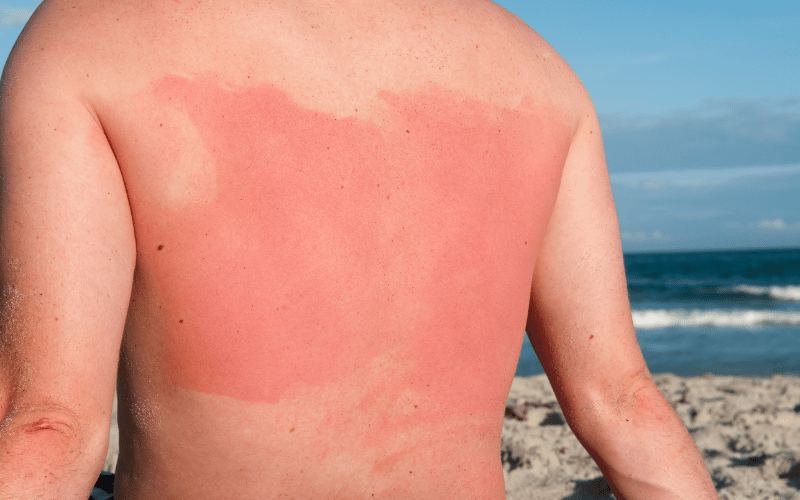 Skin Redness Photodermatitis' Initial Alert