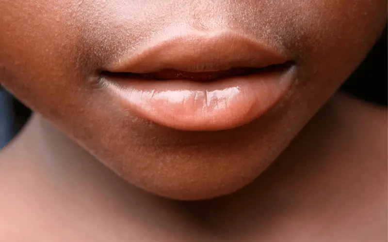 Swollen, Red Bumps on Lips or Around the Mouth The Initial Sign of a Cold Sore