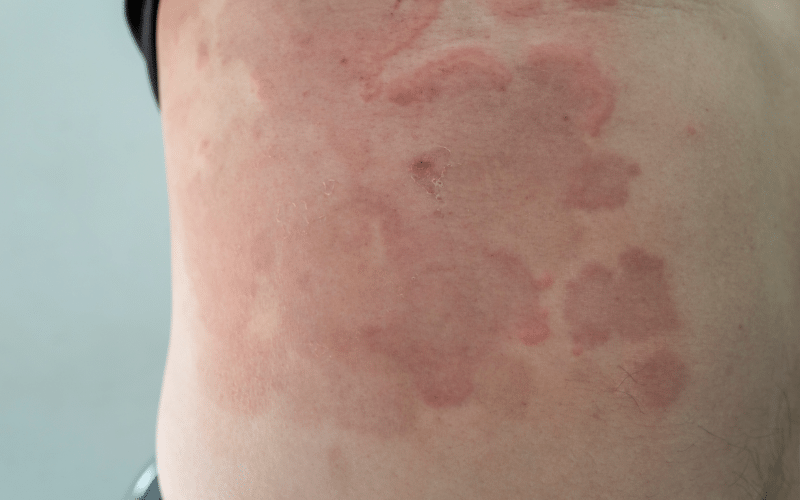 Target-Like Rashes Erythema Multiforme's Signature Mark