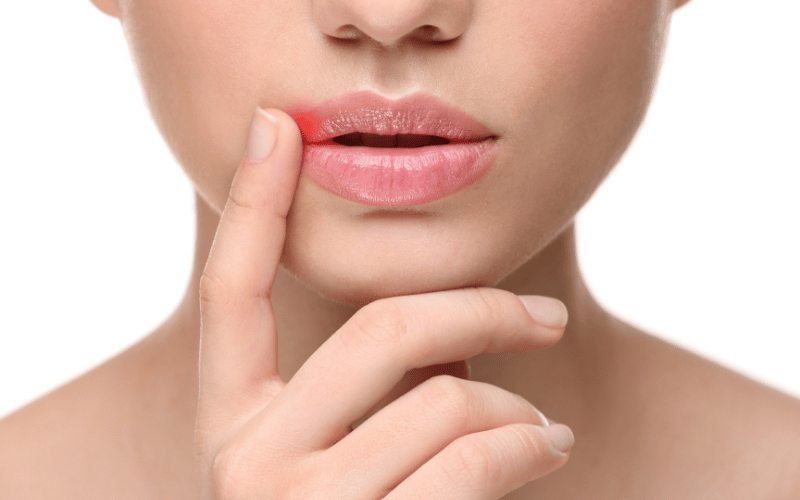 The First Tingle Cold Sore's Subtle Beginning