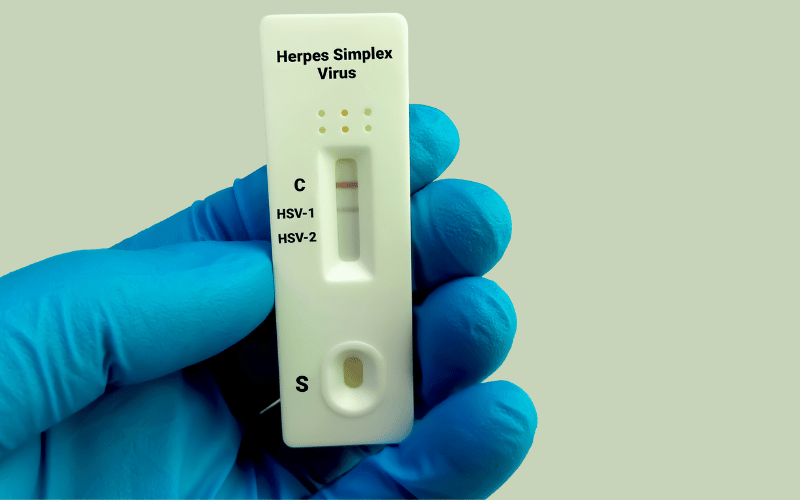 The Silent Instigator Herpes Simplex Virus (HSV)