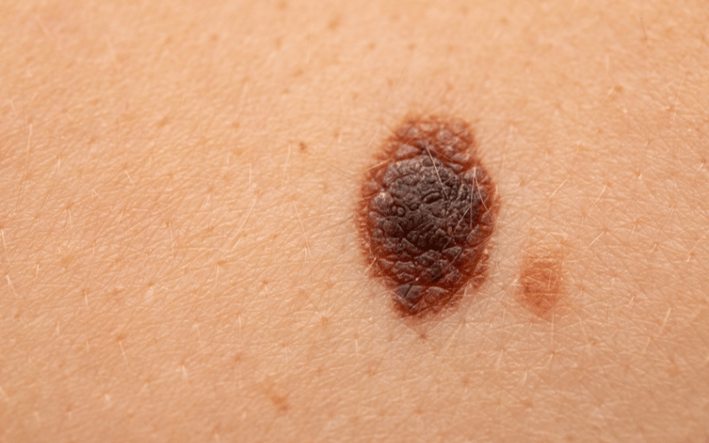 10 Alarming Symptoms of Melanocytic Nevus You Shouldn't Ignore