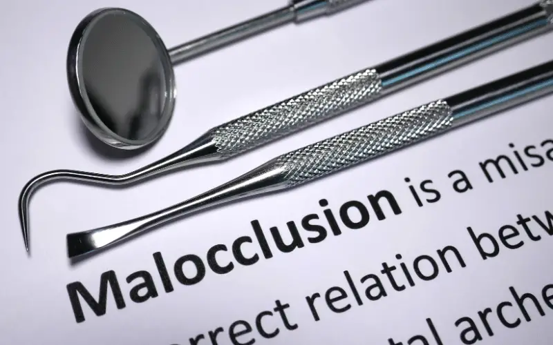 10 Essential Facts About Malocclusion You Need to Know