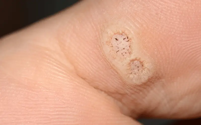 10 Essential Facts about Periungual Warts Every Individual Must Know