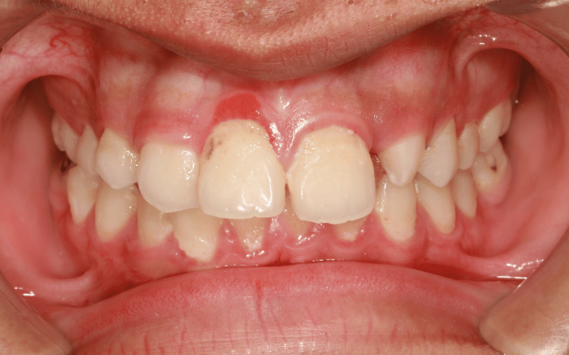 10 Home Remedies to Battle Gingivitis A Thorough Exploration