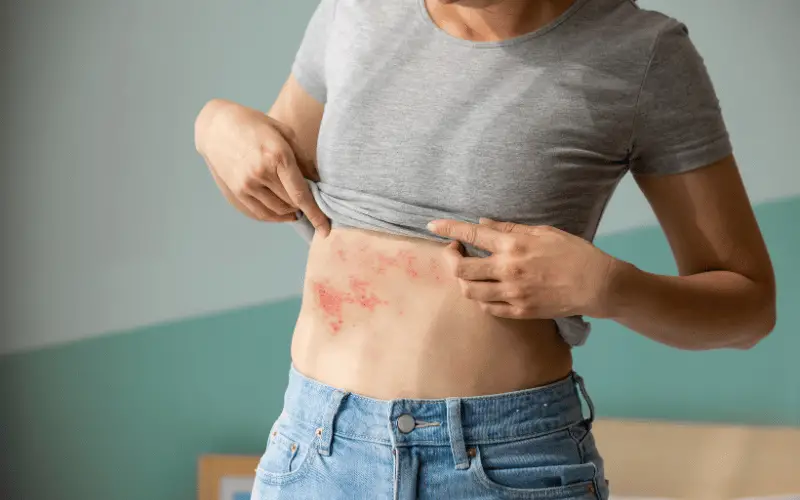 10 Powerful Home Remedies for Shingles (Zoster, Herpes Zoster)