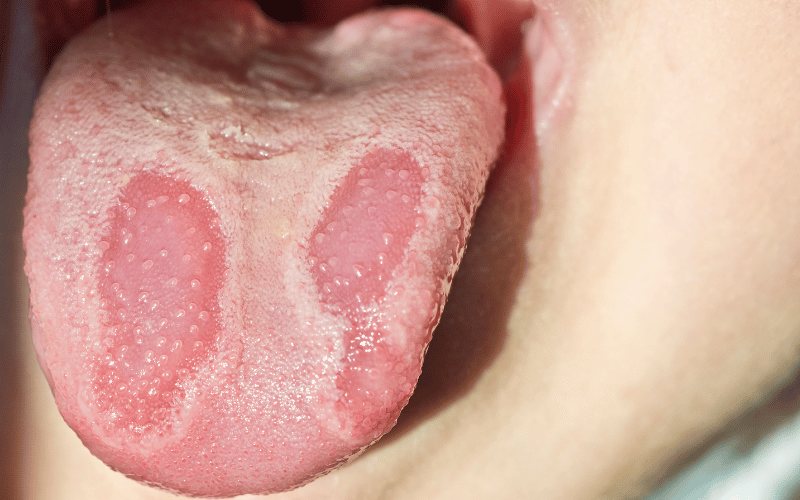 10 Proven Causes of Geographic Tongue Everything You Need to Know