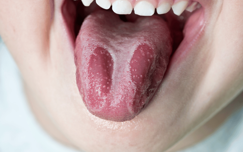 10 Tell-Tale Symptoms of Geographic Tongue in Children Everything You Need to Know