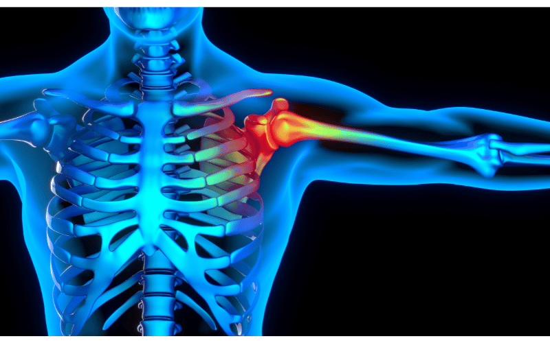 Bone Pain Tropical Sprue's Unlikely Symptom