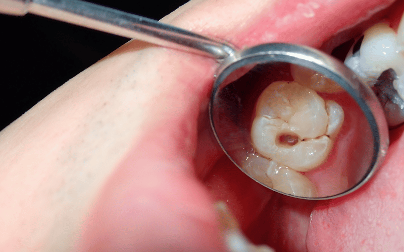 15 Essential Facts About Tooth Decay (Caries, Cavities) Every Person Should Know