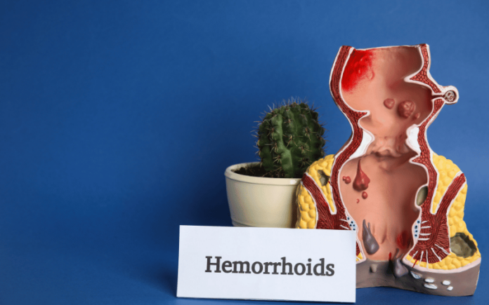 15 Essential Facts You Need To Know About Hemorrhoids (haemorrhoids)