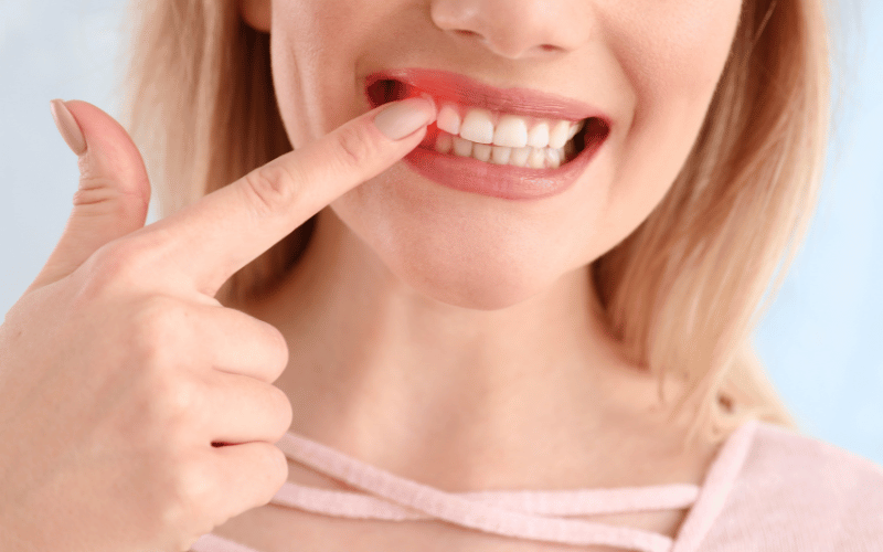 15 Essential Insights on Periodontal Abscess (Lateral Abscess)