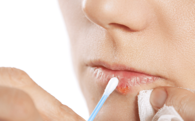 15 Must-Know Facts About Cold Sores Unveiling the Mystery of Herpes Labialis