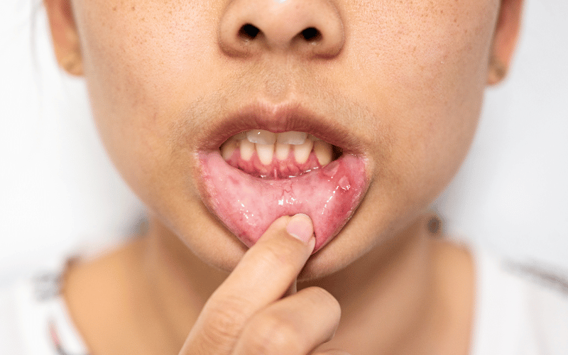 Mouth Sores The Silent Affliction of Pemphigus