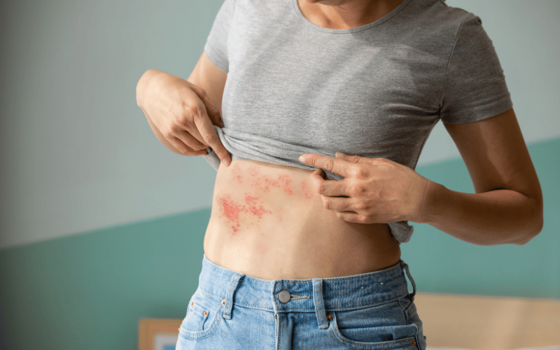 Shingles' Signature Rash More Than Meets the Eye