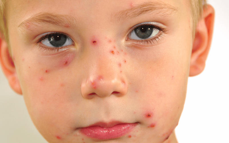 Previous Chickenpox Infection The Unsuspected Prelude